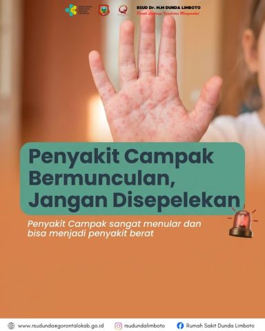 Penyakit Campak Bermunculan, Jangan Disepelekan